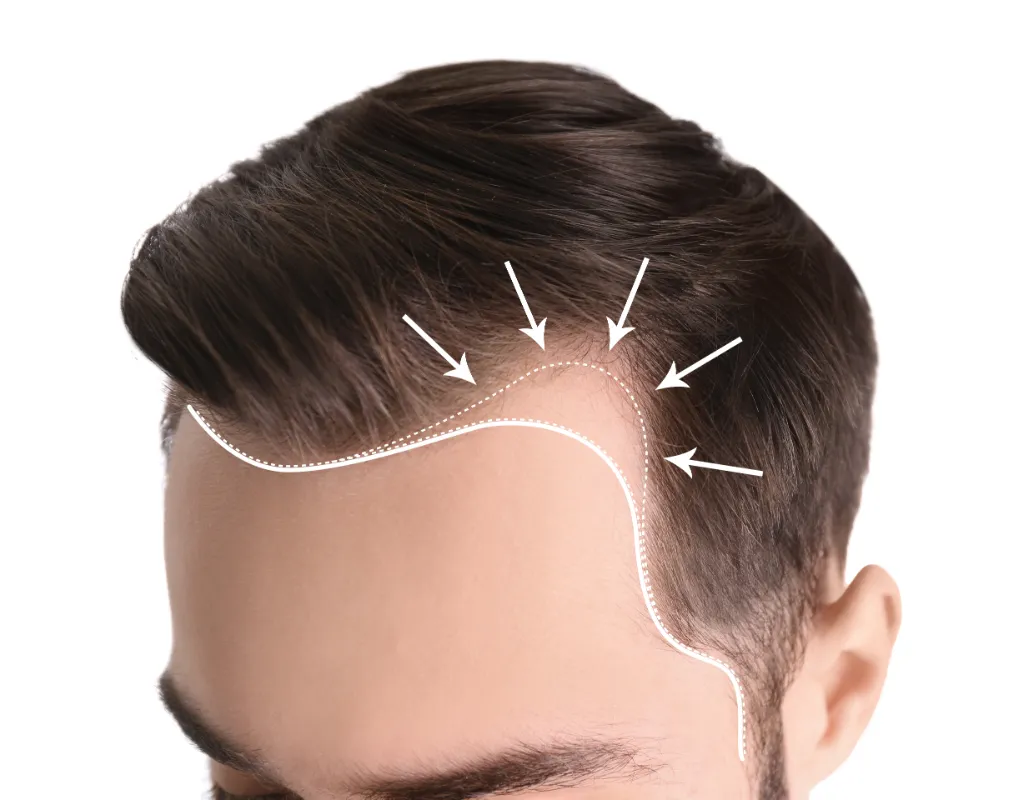 השתלה או רגנרה